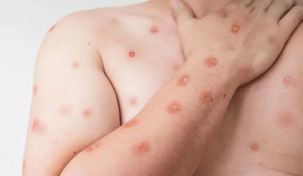 Espírito Santo Confirma Quinto Caso de Mpox em 2024: Entenda Tudo Sobre a Doença